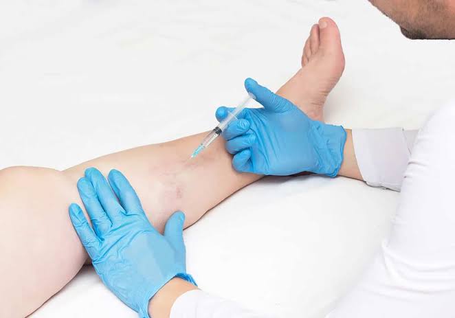 Escleroterapia